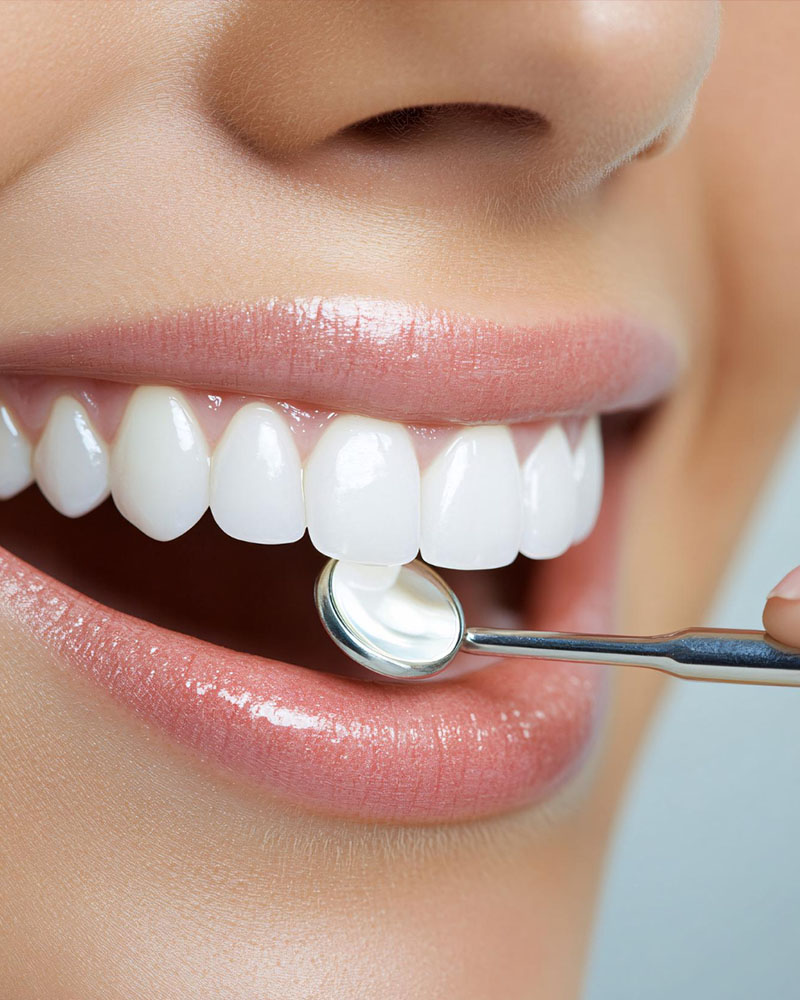 Blanchiment des dents, sourire éclatant