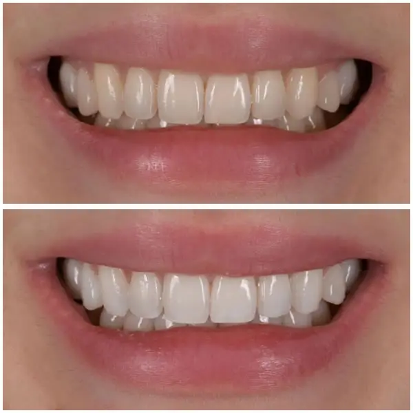Après blanchiment des dents, dents visiblement plus blanches