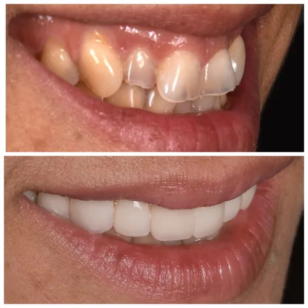 11 facettes dentaires pour enlever des taches sur les dents