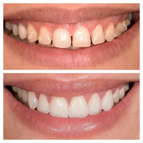 Sourire femme facettes dentaires sur mesure à Paris