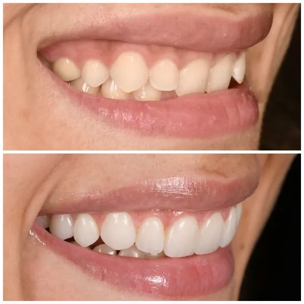Facettes dentaires avec sourirede profil avant / après