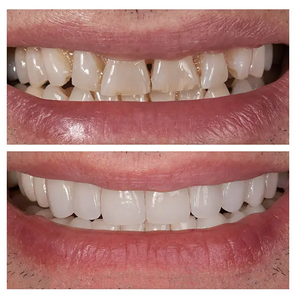 Correction sourire gingival avec la pose de facettes dentaires
