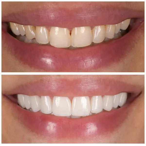 11 facettes dentaires pour enlever des taches sur les dents