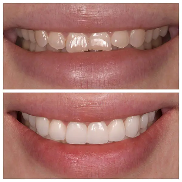 10 facettes dentaires alonger des dents trop courtes