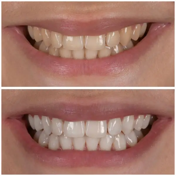 Avant blanchiment dentaire, dents jaunies