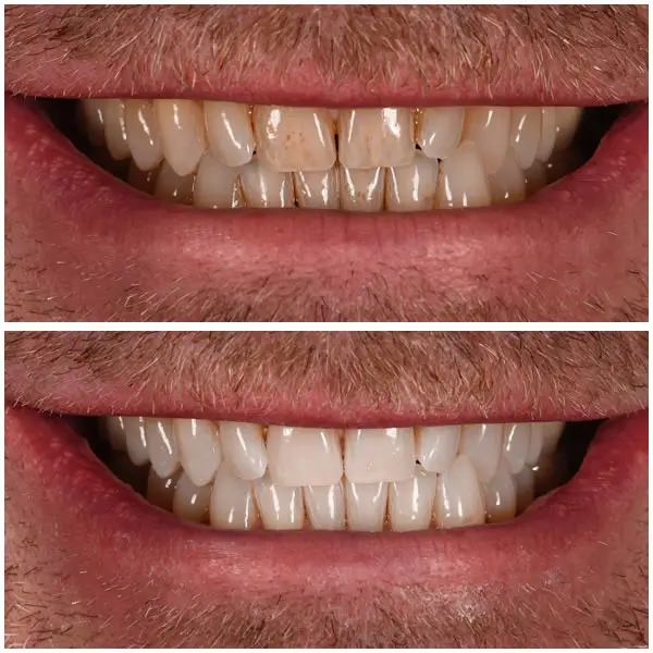 Avant et après blanchir dents, sourire avec coloration jaunâtre