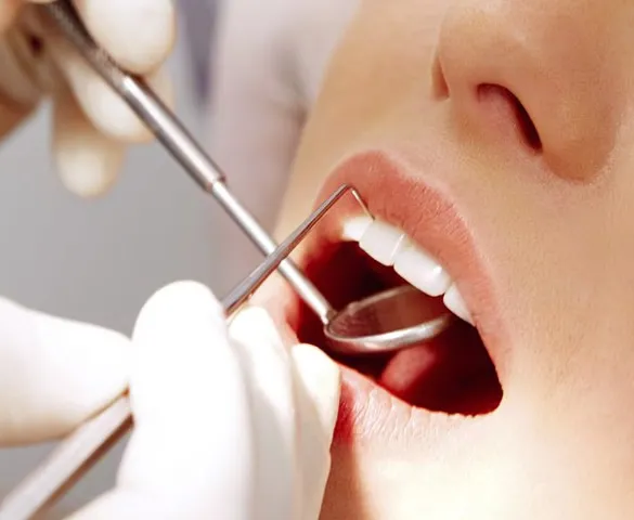 Dent fissurée : diagnostic et traitements chez Elone Clinic