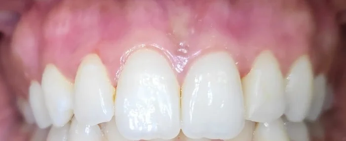 Gencives roses et uniformes après dépigmentation gingivale au laser associée à un blanchiment, Elone Clinic Paris 16e