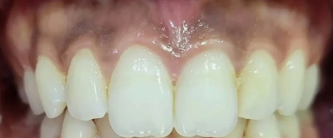 Dépigmentation gingivale au laser : traiter les gencives noires