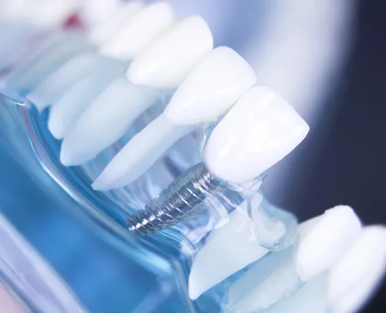 Dentiste implantologiste Paris