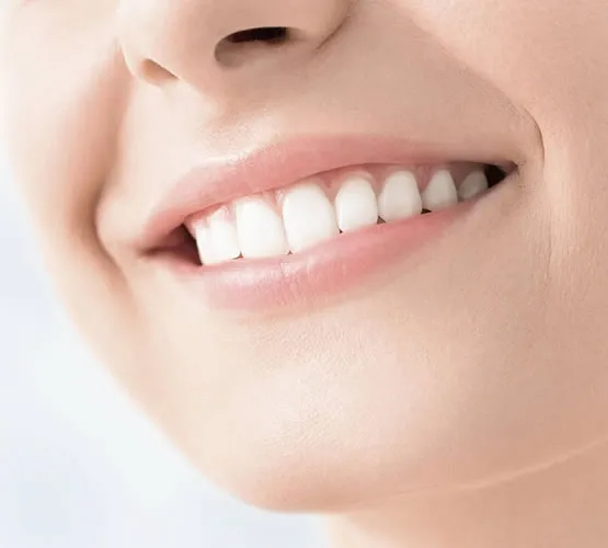 avant blanchiment des dents