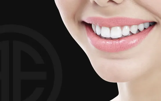 facettes dentiste