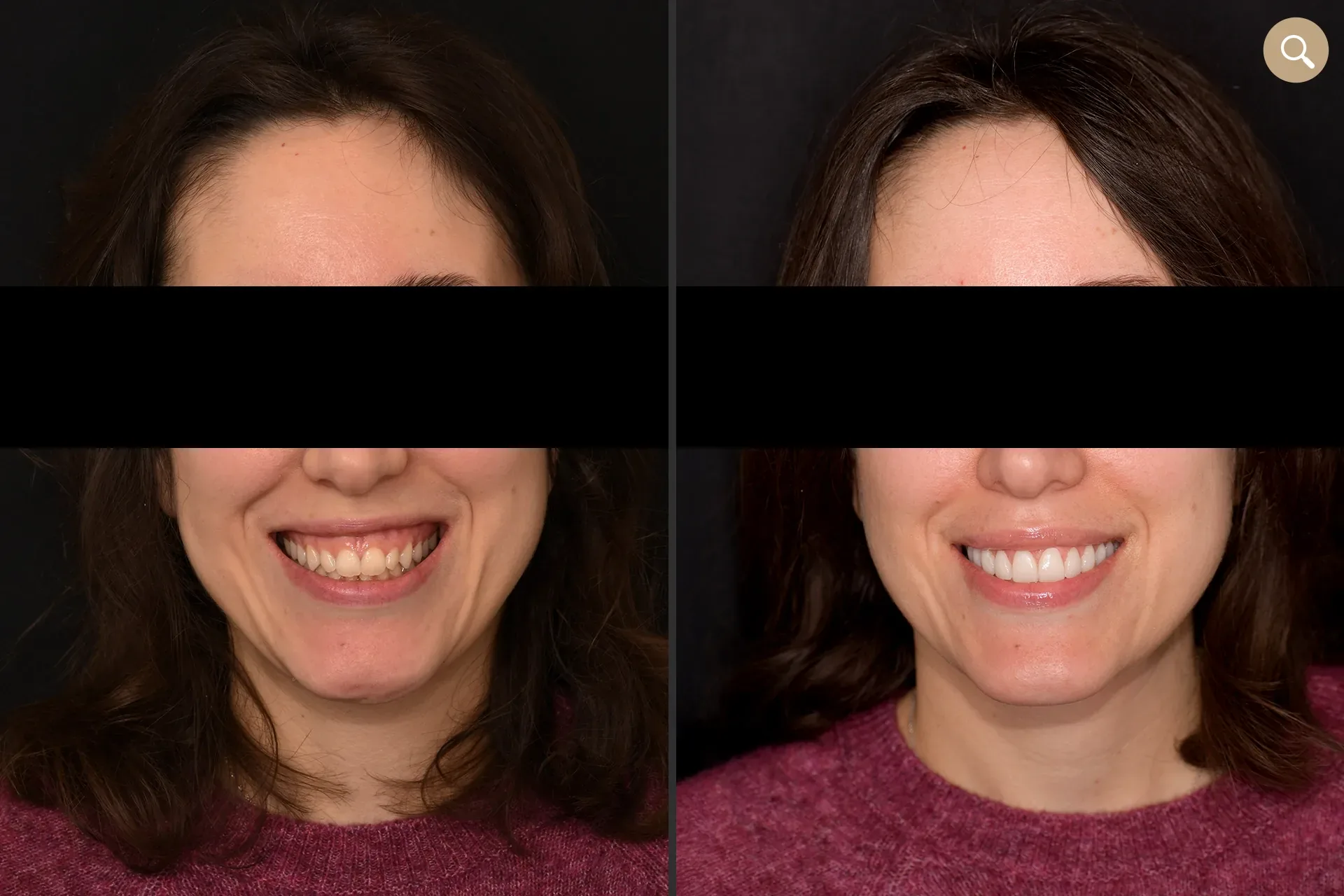 Belle femme sourire de star avec des facettes dentaires sur mesure
