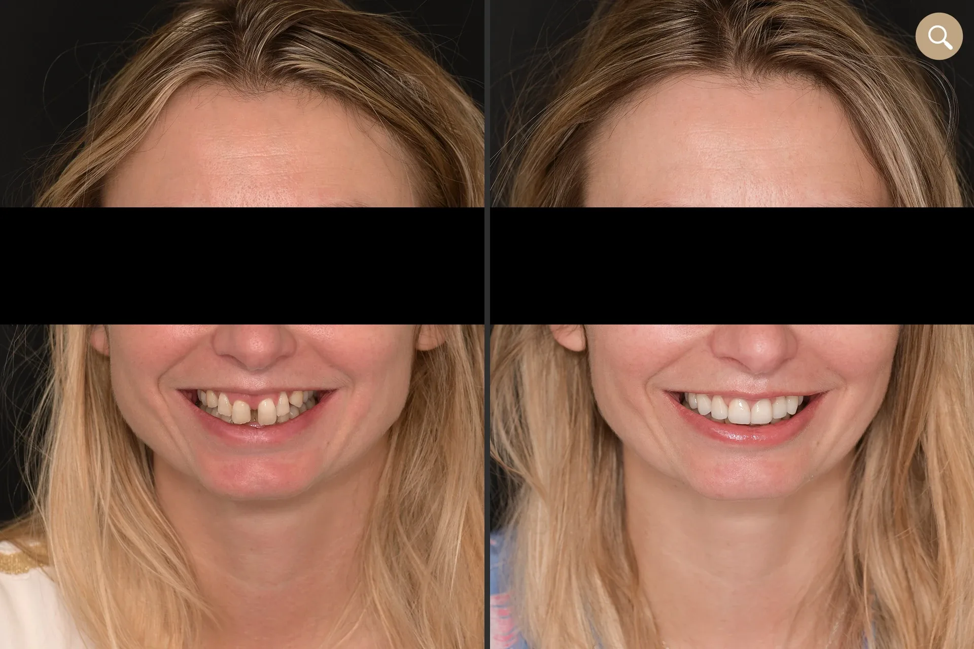 résultat pose de facettes dentaires sur homme de 35 ans