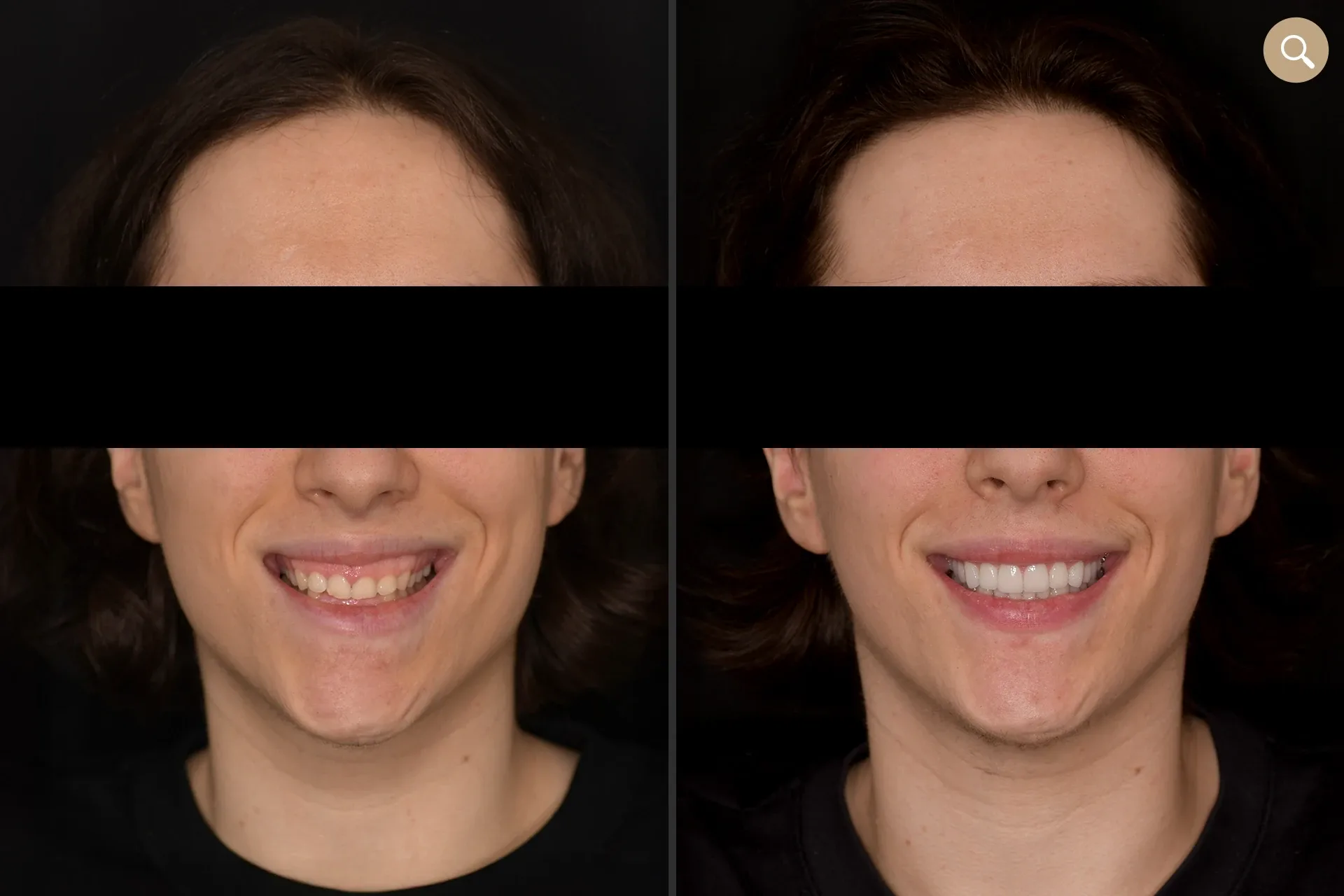 facettes dentaire et alignement des dents