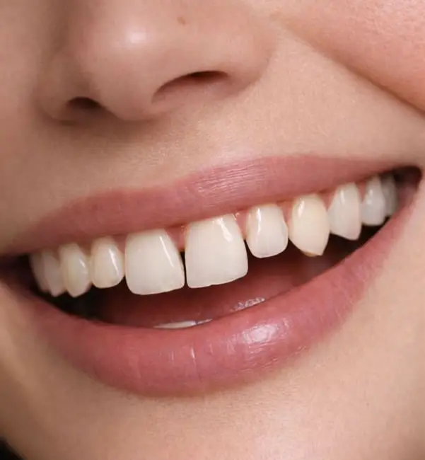 dents écartées d'une femme