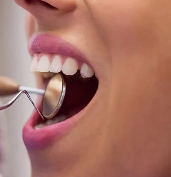avant blanchiment des dents