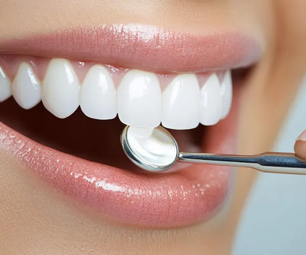 avant blanchiment des dents