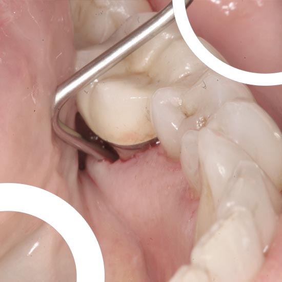 exemple d'un abcès dentaire à la suite d'une pose d'implant