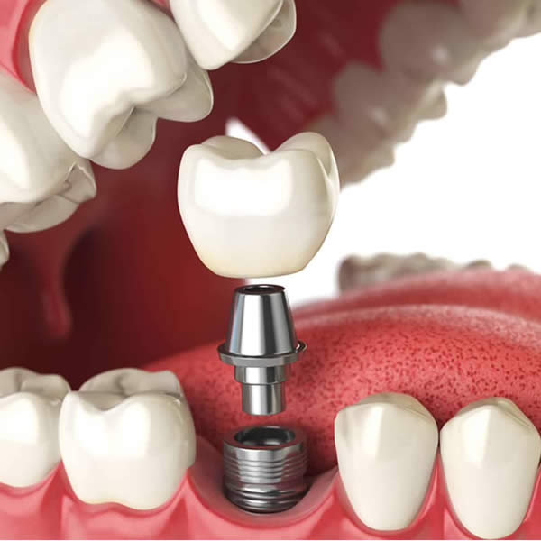implant dentaire