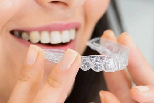 Invisalign Paris : le traitement orthodontique invisible pour révéler votre sourire