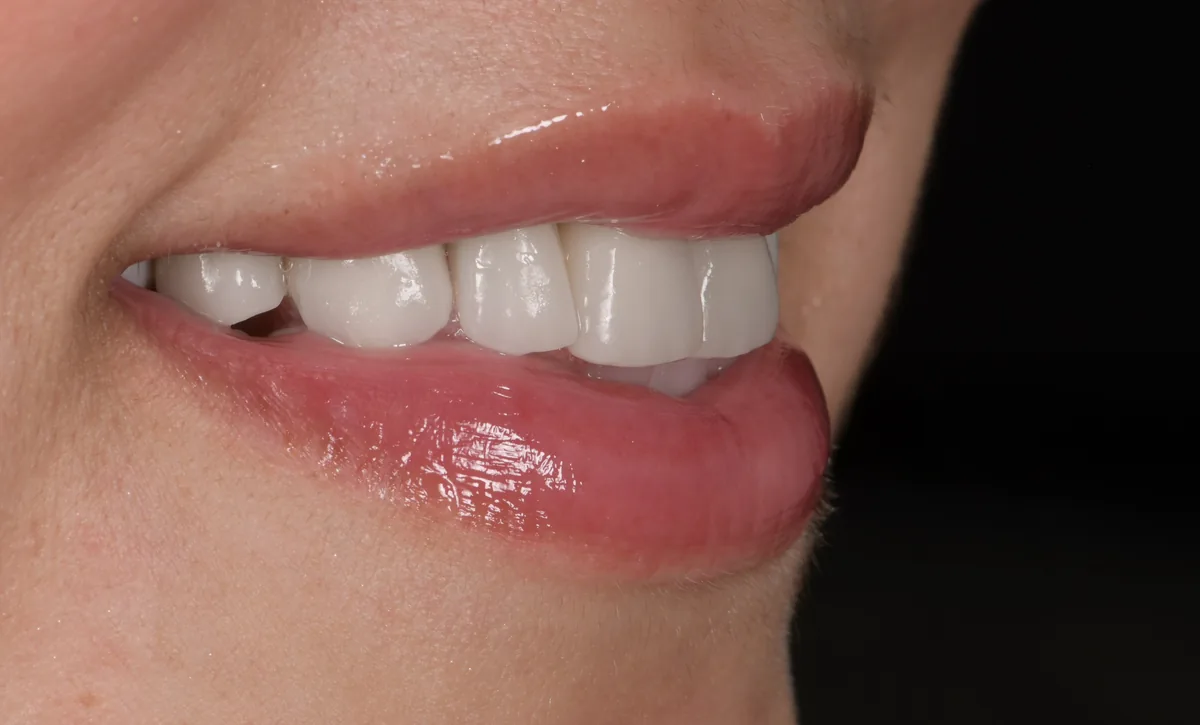 Couronnes individuelles sur implants, chaque dent restaurée séparément, Elone Clinic Paris 16e