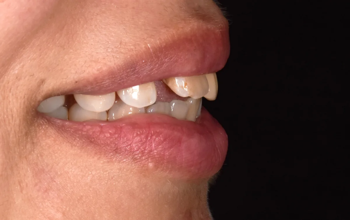 Dents délabrées avant remplacement par des couronnes sur implants, Elone Clinic Paris 16e