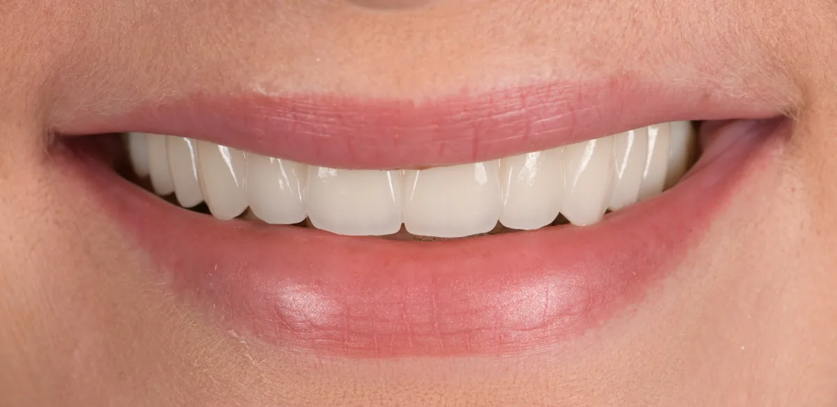 Sourire homogène après réhabilitation prothétique complète, Elone Clinic Paris 16e
