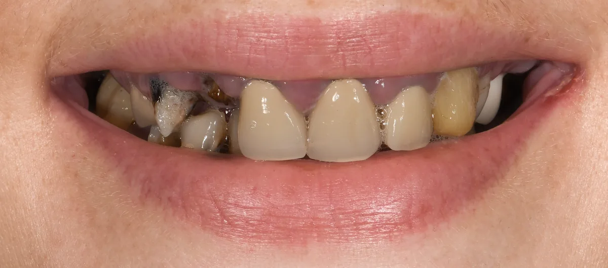 Dents très délabrées avec caries avant réhabilitation complète, Elone Clinic Paris 16e