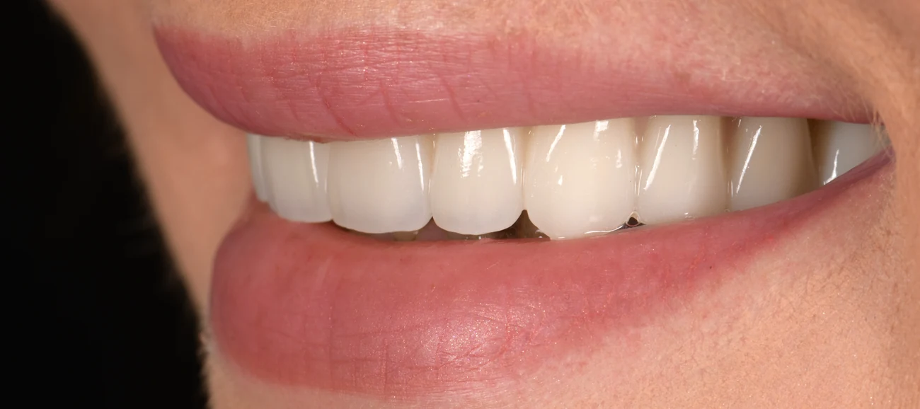 Sourire blanc et homogène après réhabilitation prothétique, Elone Clinic Paris 16e