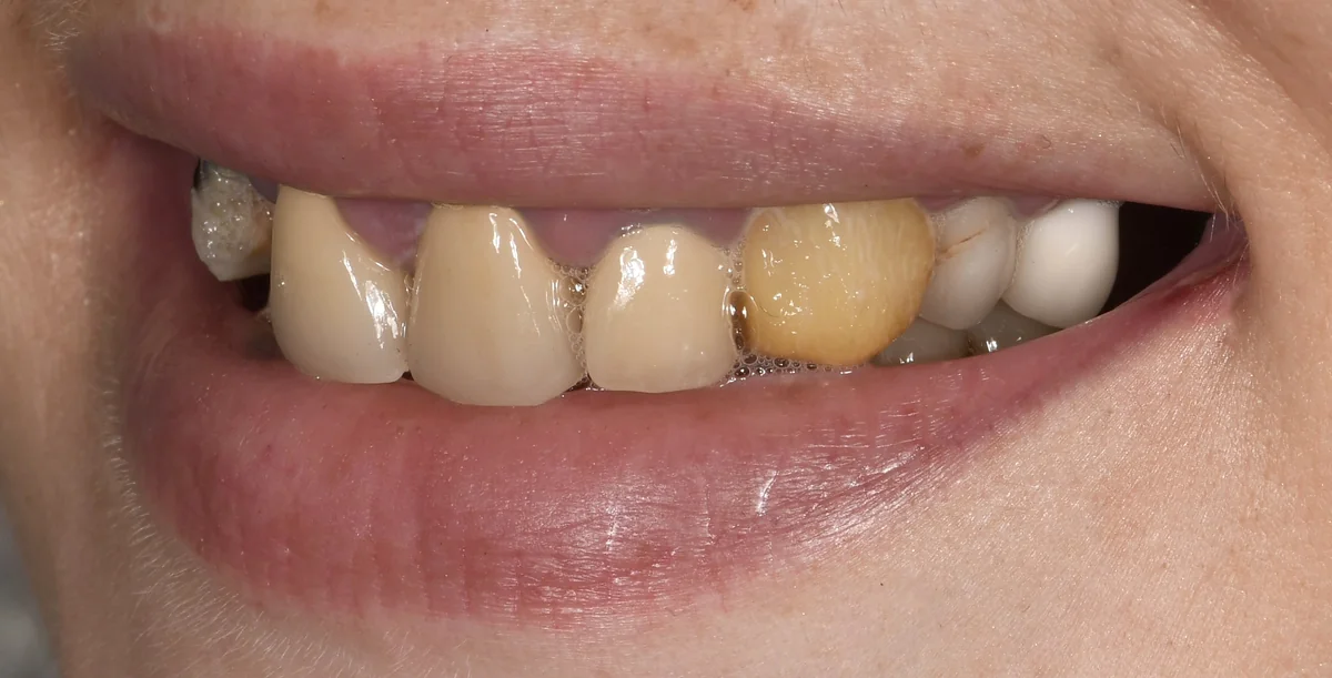 Dents jaunies et hétérogènes avant réhabilitation prothétique, Elone Clinic Paris 16e