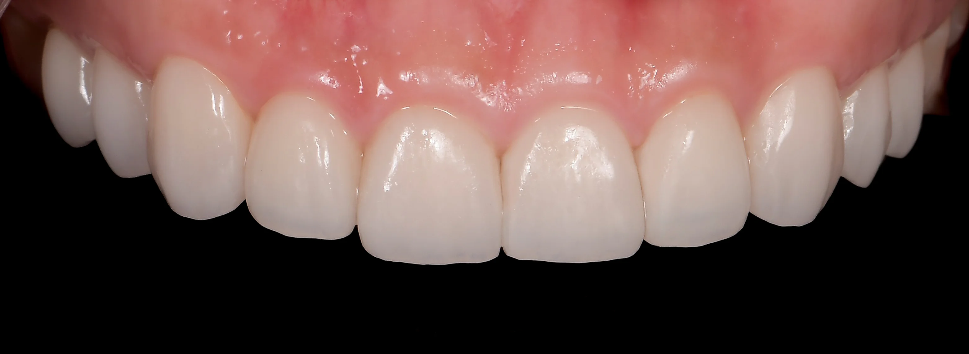 Dents restaurées après traitement de l'usure, Elone Clinic Paris 16e
