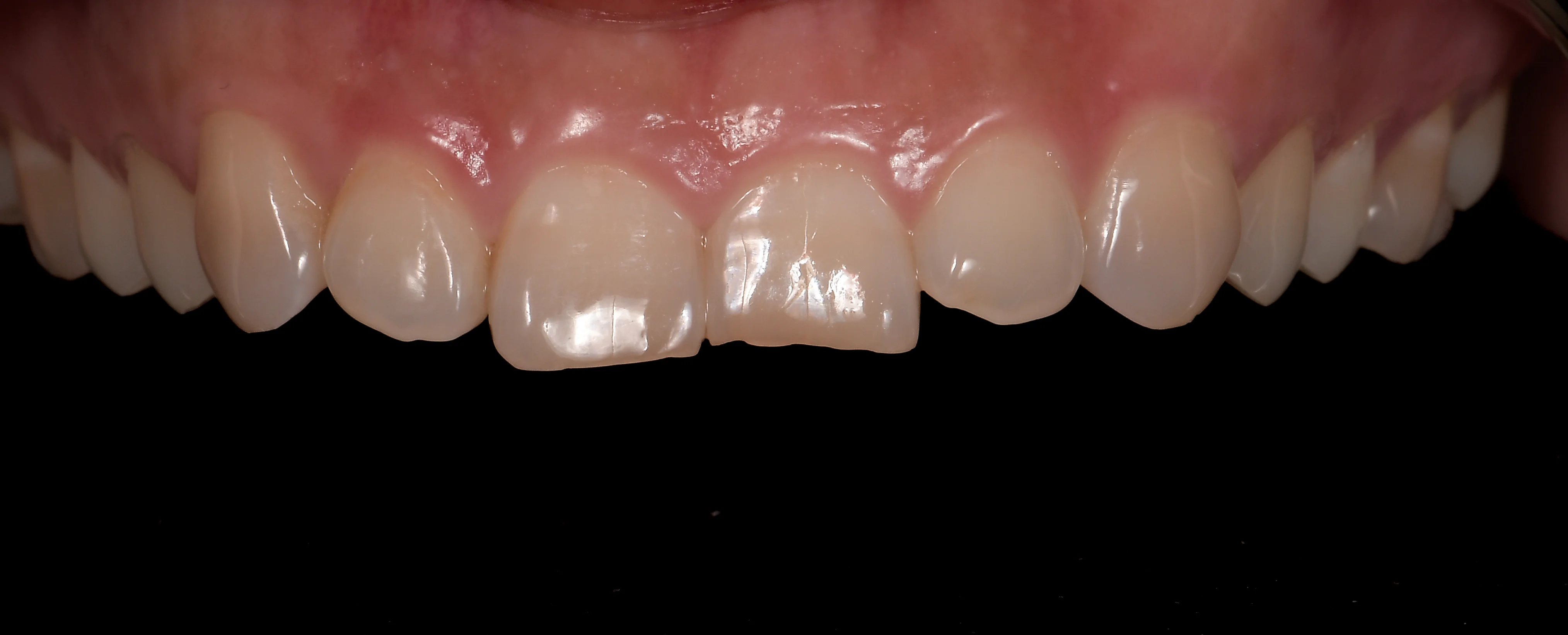 Dents usées avant traitement, Elone Clinic Paris 16e