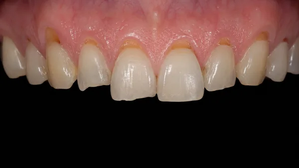 Usure dentaire par abrasion : usure au collet des dents près de la gencive