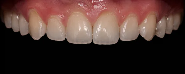 Usure dentaire par érosion : surfaces lisses et émail aminci par les acides