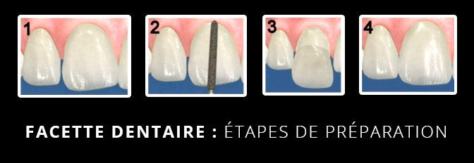 Pose de facettes dentaires à Paris 16