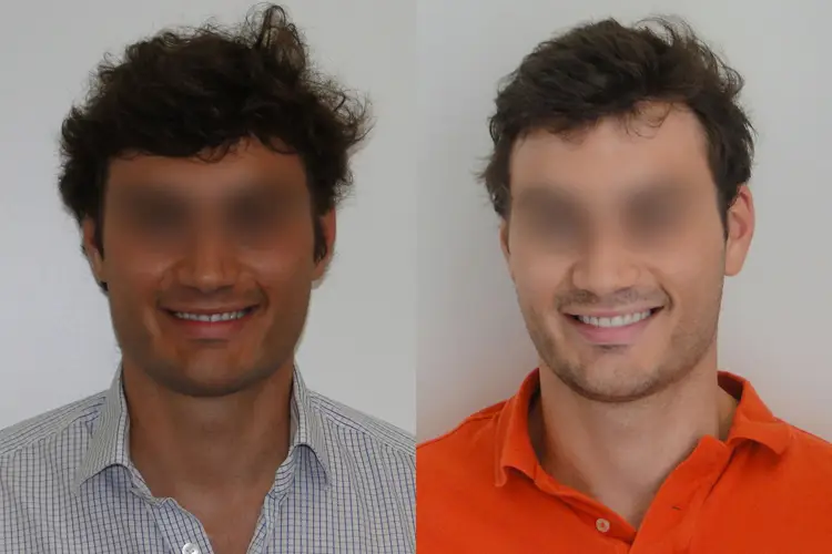 résultat pose de facettes dentaires sur homme de 35 ans