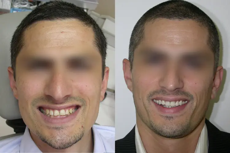 facettes dentaire et alignement des dents