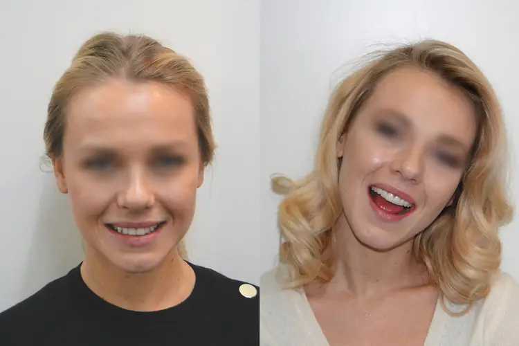 Belle femme sourire de star avec des facettes dentaires sur mesure