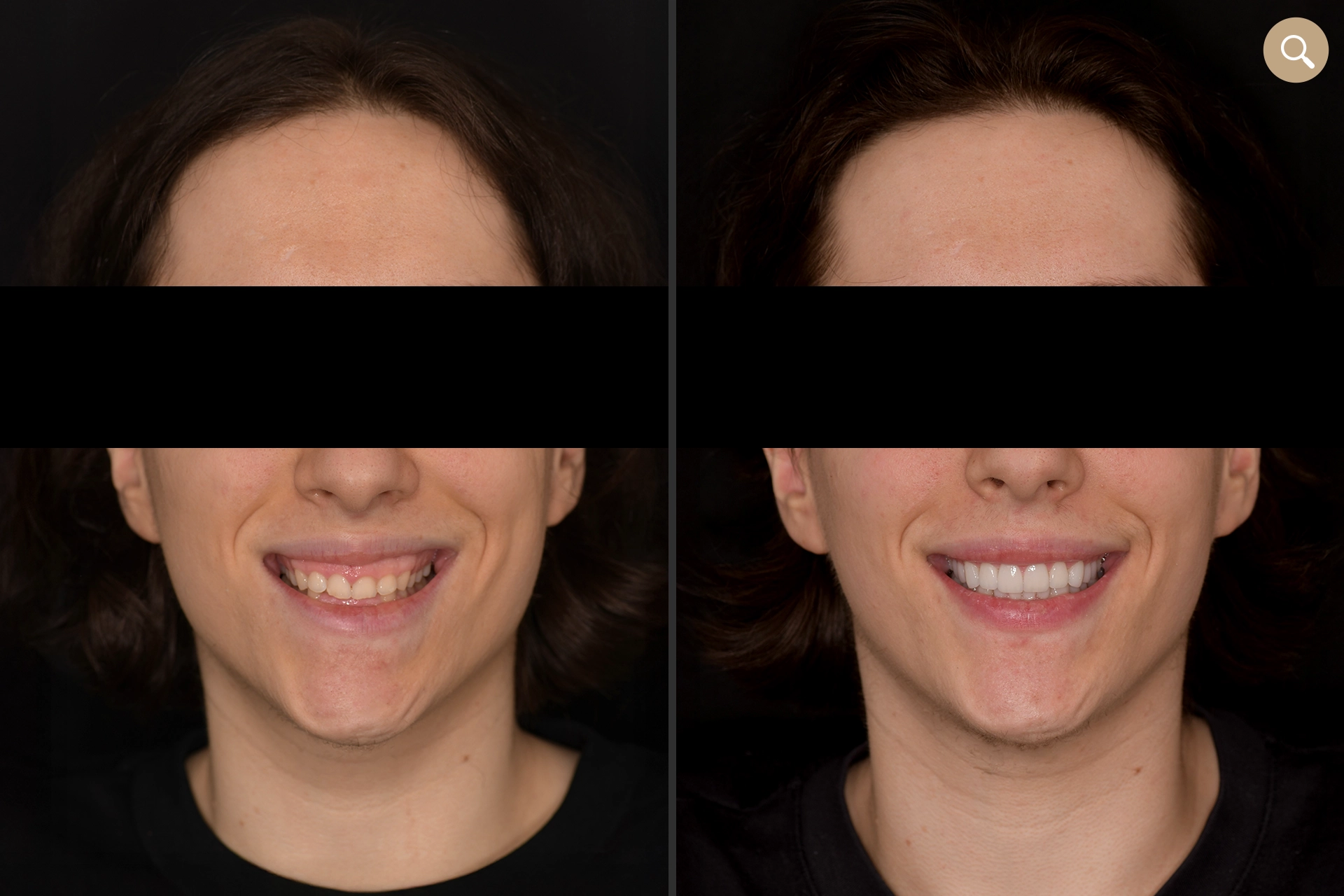 Ceramic veneers for short teeth, Elone Clinic Paris 16