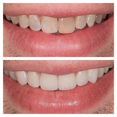 avant et après pose de facettes dentaires jeune homme