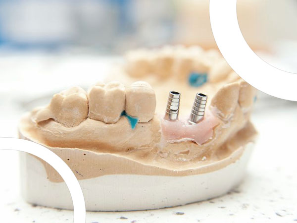 Cette empreinte dentaire avec un exemple de pose d'implant via la techinque du sinus lift
