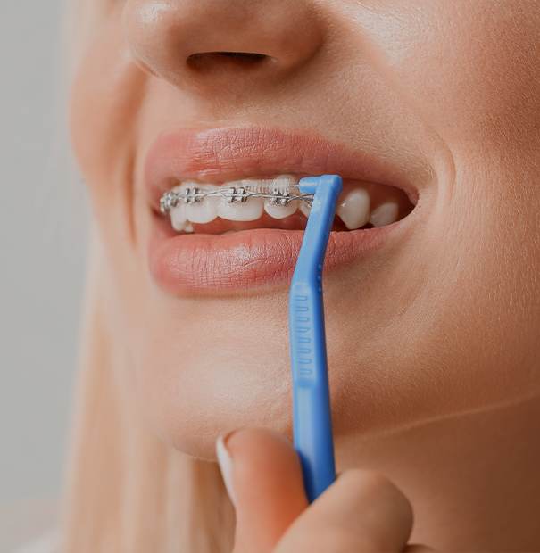 Comment enlever les taches sur un appareil dentaire ?
