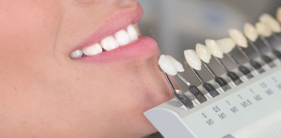 tarif blanchiment des dents chez le dentiste