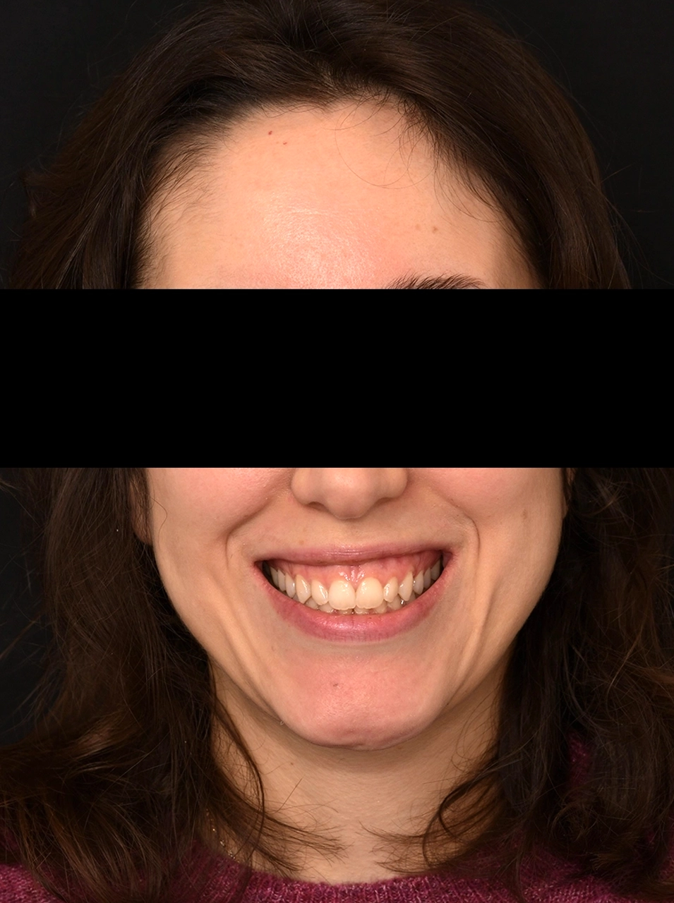 Avant facettes dentaires - Elone Clinic Paris