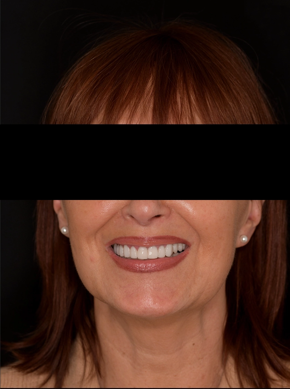 Apres facettes dentaires - Elone Clinic Paris