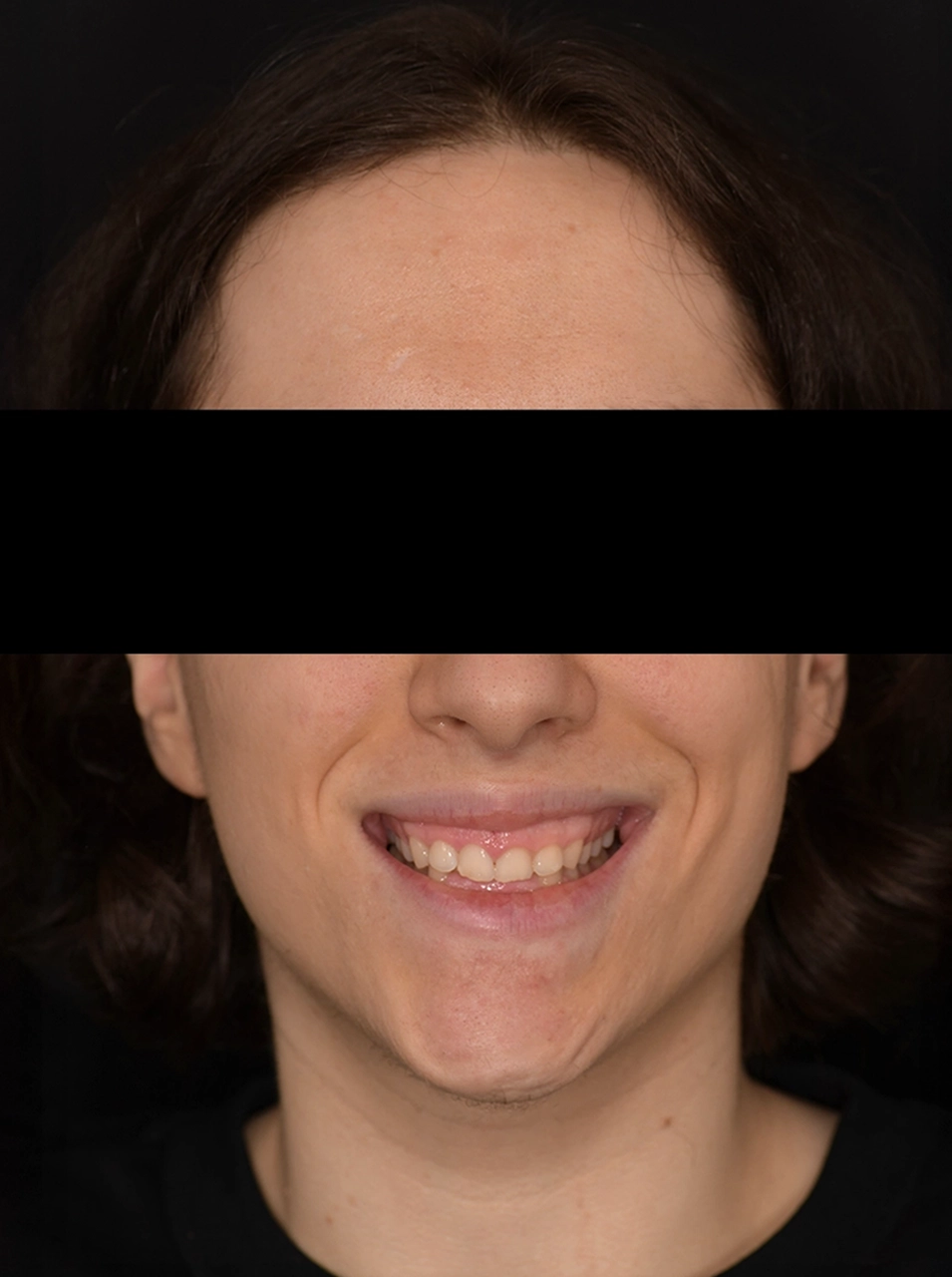 Avant facettes dentaires - Elone Clinic Paris
