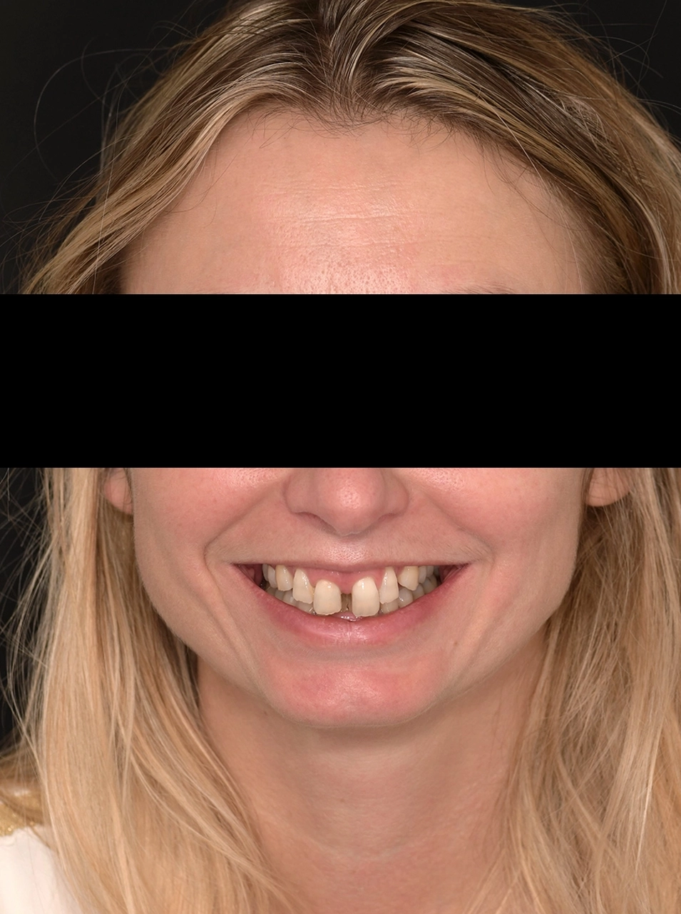 Avant facettes dentaires - Elone Clinic Paris
