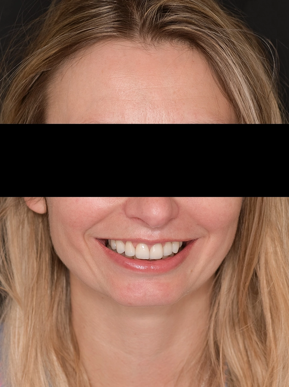 Apres facettes dentaires - Elone Clinic Paris